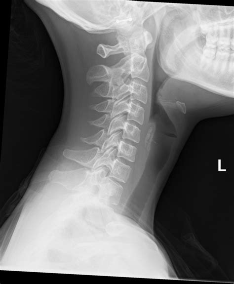 normal soft tissue neck x-ray|lateral soft tissue neck x ray.
